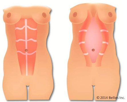Two images of abdominal muscles, one showing diastasis recti