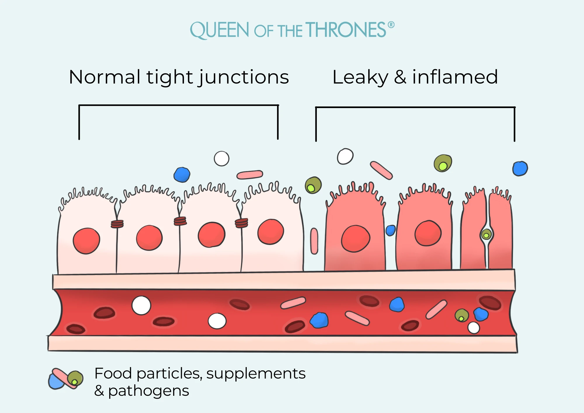 Leaky & Inflamed gut illustration by Queen of the Thrones