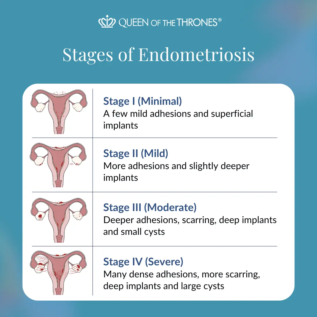 Stages of Endometriosis by Queen of the Thrones
