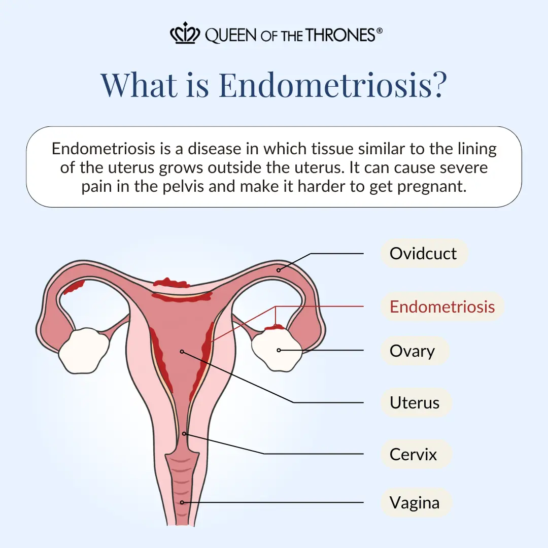 What is endometriosis by Queen of the Thrones