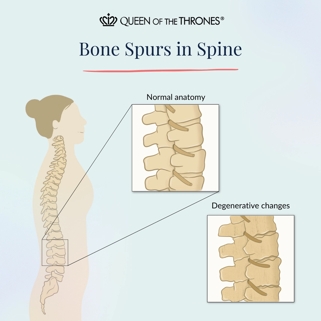 Bone spurs in spine by Queen of the Thrones