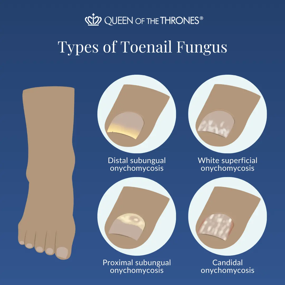 Types of toe nail fungus by Queen of the Thrones