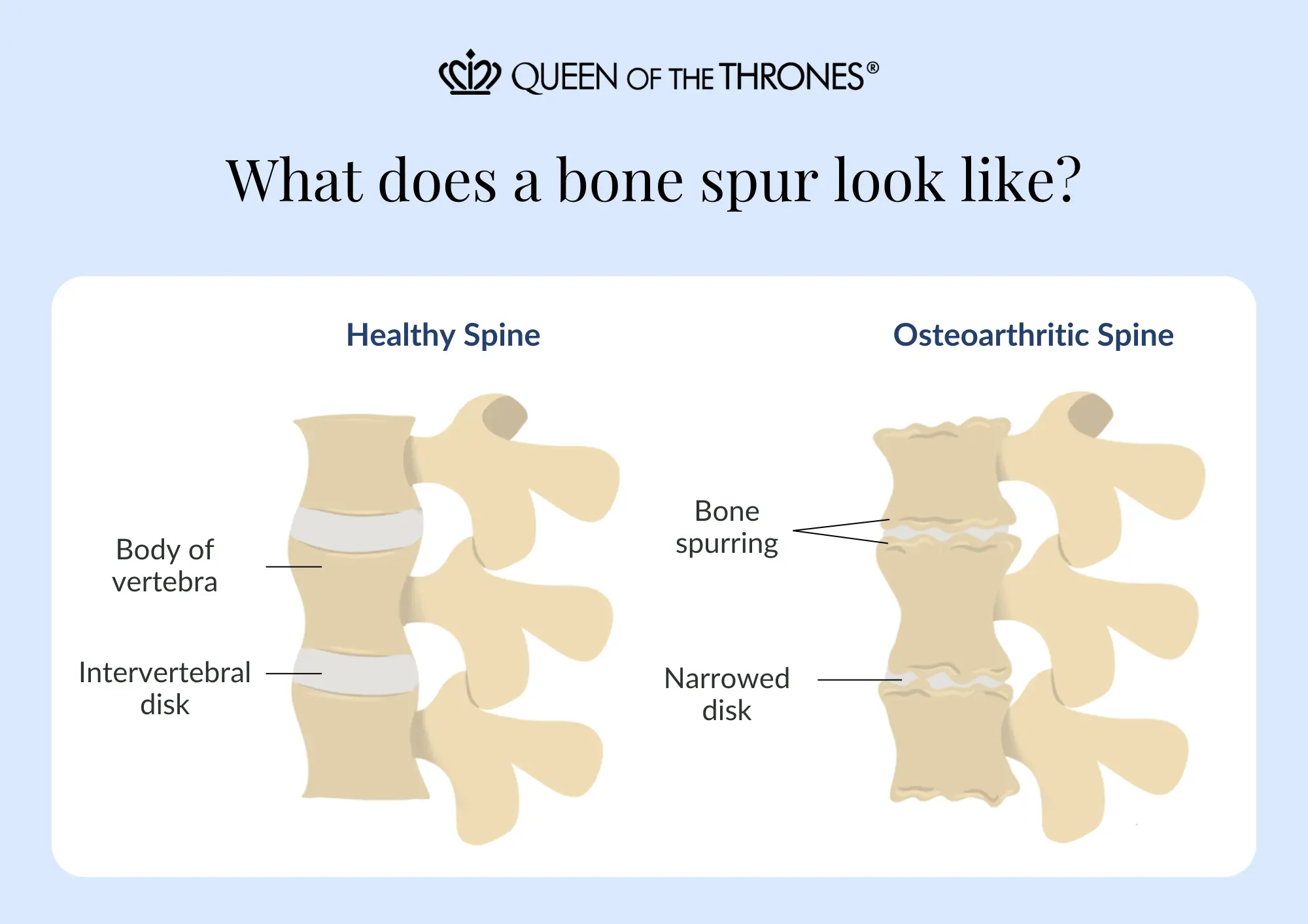 What does a bone spur look like by<br />
Queen of the Thrones